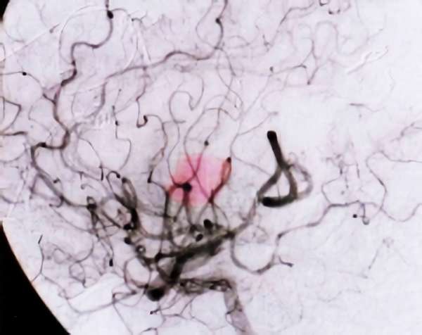 手術後（脳血管撮影画像）1