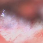 No.’25_114　摘出 前