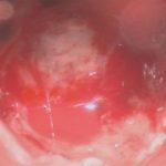 No.’25_114　 摘出 中