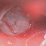 No.’25_114　摘出 後