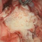 No.’26_17　 摘出 中