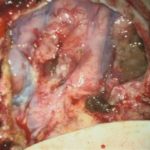 No.’26_17　摘出 後