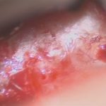 No.’26_5　摘出 前