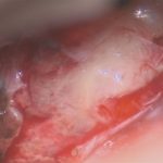 No.’26_5　 摘出 中