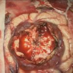 No.’25_108　摘出 前