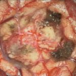 No.’25_108　摘出 後