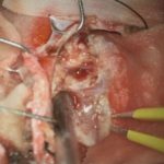 No.’25_97　 摘出 中