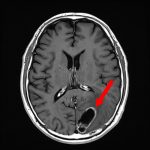 No.’25_110　手術前1