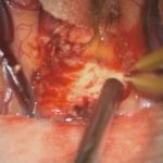 No.’25_110　摘出 前