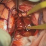 No.’25_110　 摘出 中