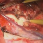 No.’25_110　摘出 後