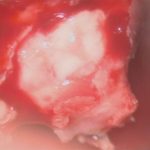 No.’25_112　摘出 前