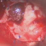 No.’25_112　 摘出 中