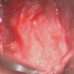 No.’25_112　摘出 後