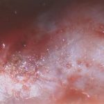 No.’25_84　摘出 前