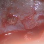 No.’25_84　 摘出 中