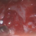 No.’25_84　摘出 後