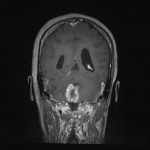 No.’25_94　手術前2