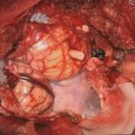 No.’25_94　摘出 前