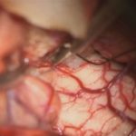 No.’25_94　 摘出 中