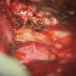 No.’25_94　摘出 後