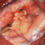 No.’26_12　摘出 前