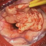 No.’26_12　 摘出 中