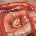 No.’26_12　摘出 後