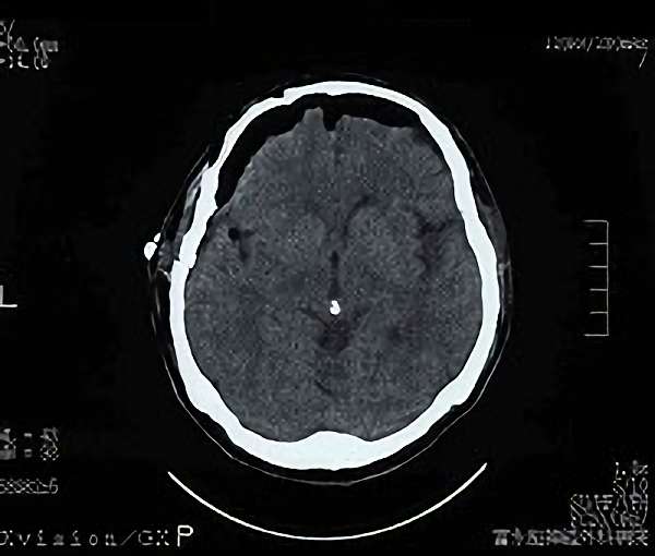 手術後（脳血管撮影画像）1