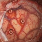 No.’26_3　摘出 前