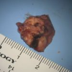 No.’26_3　摘出 後