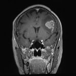 No.’25_99　手術前2