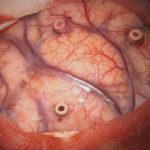 No.’25_99　摘出 前