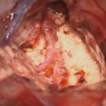 No.’25_99　摘出 後