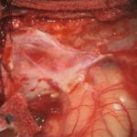 No.’25_111　摘出 前