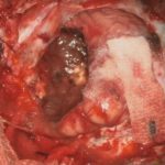 No.’25_111　摘出 後