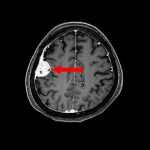 No.’25_92　手術前1