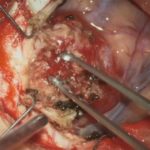 No.’25_92　摘出 前