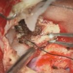 No.’25_92　 摘出 中