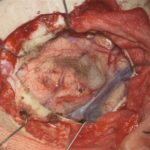 No.’25_92　摘出 後