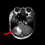 No.’25_86　手術前1