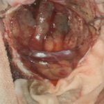 No.’25_86　摘出 前