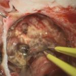 No.’25_86　 摘出 中