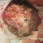 No.’25_86　摘出 後