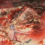 No.’25_117　摘出 前