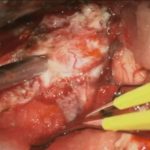 No.’25_117　 摘出 中