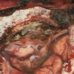 No.’25_117　摘出 後