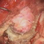 No.’25_98　摘出 前