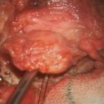 No.’25_98　摘出 中