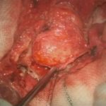 No.’25_98　摘出 後